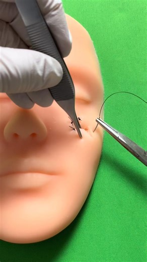 Limberg flap (part 4) | Dermhacks