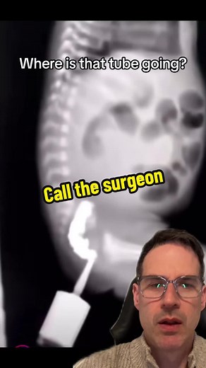 Detecting Bowel Obstruction in Newborns Using Barium