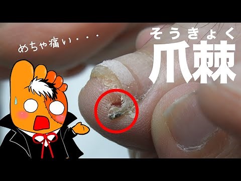 【激痛】甘く見てはいけない爪棘【巻き爪先生 Vol. 16 】by Pincer Nails treatment Center®︎
