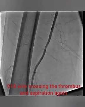 aspiration thrombectomy using the #penumbra#