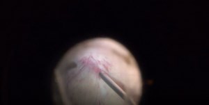 Surgical Management of CRVO - Eyetube