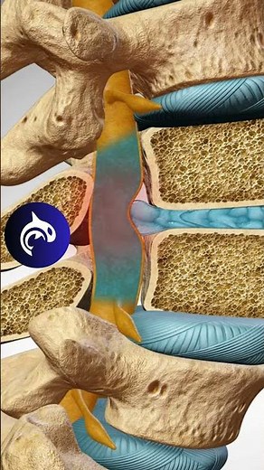 Lumbar Intervertebral Disc Herniation - 4K 3D Animation
