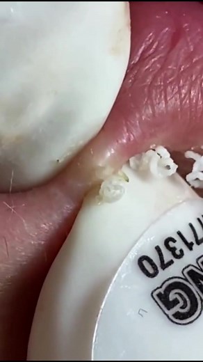 vedio from :acne treatment huong beauty#fyp #foryou #explore #makeup #RayBanElevatorDance