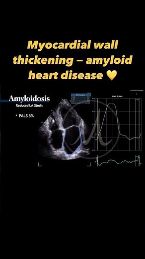 #amyloidosis in #echocardiography #heartfailure #heartdisease