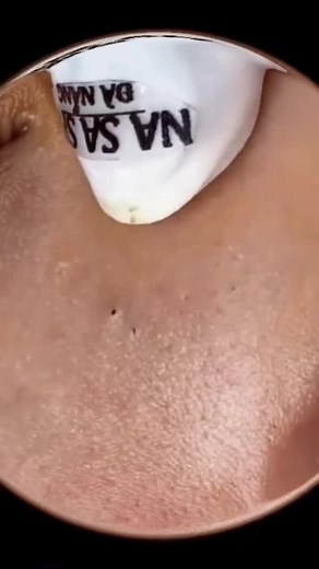 Big pimple blackhead removal #acne #pimple #blackhead #extractions #satisfying