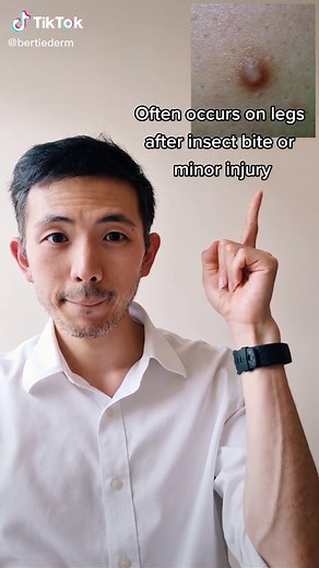 Understanding Dermatofibroma: Symptoms, Causes, and Treatment