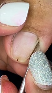 Very smooth cleaning #ingrowntoenailremoval | Ingrown Queen Vlogs