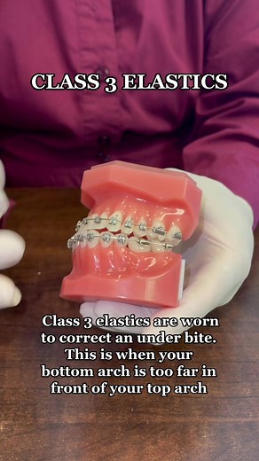 Understanding Class 3 Elastics for Under Bite Correction