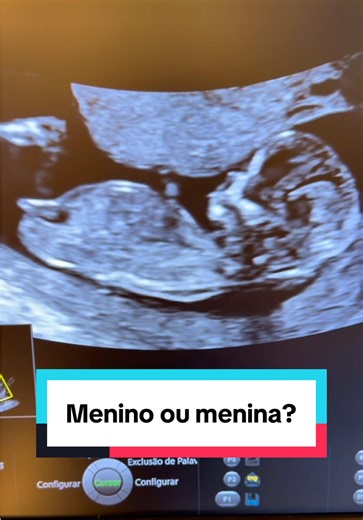 Descubra o Sexo do Bebê: Menina ou Menino?