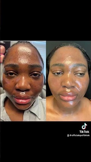 #Moxi On DARK SKIN! Choose Your Laser Center carefully #dmvlaser #bolusmedspa #maryland #beauty