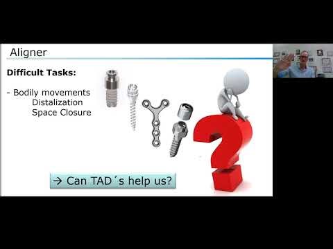 18 Distalization and space closure with aligners