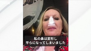 病気で鼻が崩壊、切除……付け鼻で人生を取り戻した女性の話 - BBCニュース