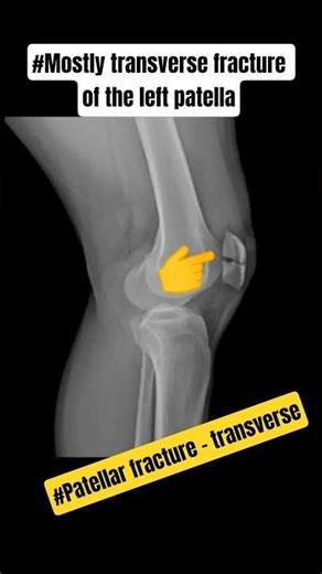 Mostly transverse fracture of the left patella#shortvideo