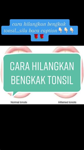 2 Cara Mudah Untuk Hilangkan Bengkak Tonsil . Sakit anak tekak ataupun bengkak tonsil boleh terjadi pada sesiapa saja. Tak kira umur samada kanak-kanak ataupun yang dewasa. . Kebiasaanya kita dengar orang tua-tua cakap “mesti badan hang nie kurang air, tue jadi bengkak tue”. Nak menunjukkan yang dalaman badan kita “panas” hingga tonsil boleh membengkak. . Tonsil sebenarnya adalah sebahagian sistem pertahanan badan kita. Tonsil bertindak untuk menghalang bakteria yang cuba masuk melalui saluran p