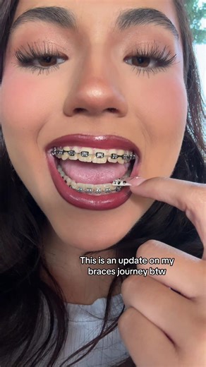 I still have a couple more visits but they’re pretty straight rn!!! #bracesjourney