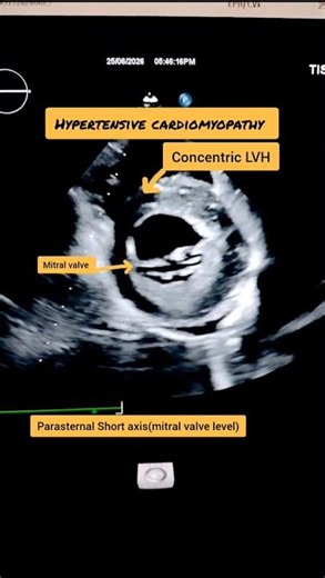 Hypertensive Cardiomyopathy Explained!
