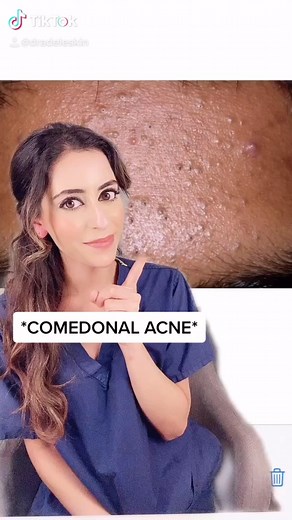 Dr Aamna Adel on Instagram: "COMEDONAL ACNE Comedonal acne is a type of non-inflammatory acne which is made up of ‘blackheads’ and ‘white heads’. Blackheads are also known as ‘open comedones’ and represent open clogged pores. They contain oil and dead skin cells and have a partial opening to the skin surface. Whiteheads are also known as ‘closed comedones’ and represent closed clogged pores. The surface of these lesions is not open to the surface. They present as skin coloured bumps. Comedonal a