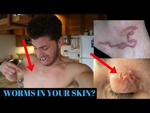 Kill Parasites Naturally | Worms Under Your Skin