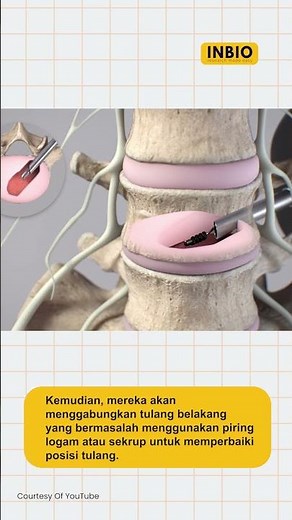 Lower spinal fusion surgery