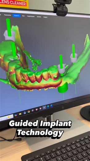 St Anthony Dental Five Dock | Dr Robert Aslan on Instagram: "At St Anthony Dental, we use guided implant technology to create the most precise implant placement. Our Doctors and skilled technician use our 3D software integrated with your 3D scan to plan your implant placement with absolute accuracy (to the micron). We use this design to manufacture your implant guide onsite, using our 3D printer allowing for precise, accurate and predictable results. #fivedock_sydney #dental #innerwest"