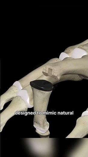 This is what happens in a knuckle replacement