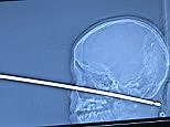 Boy survives after being impaled in the face by 12-inch skewer