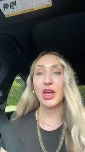 If you want natural lip filler you must be aware that not all fillers are created equal. The product you choose will determine whether the lips will look natural or fake. If you choose the wrong lip filler you may end up dissolving your lips due to filler migration. #lipfiller #natural #lips #dissolvinglipfiller #fillermigration #naturallipfiller