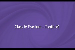 OMNICHROMA Procedure With Dr. Kevin Brown: Class IV Fracture, Tooth #9, with Mylar Strip - Dentistry Today