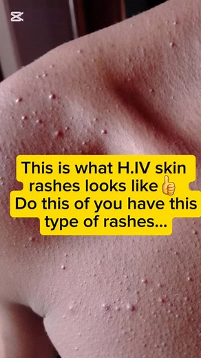 Understanding HIV Skin Rashes and Skin Health Tips