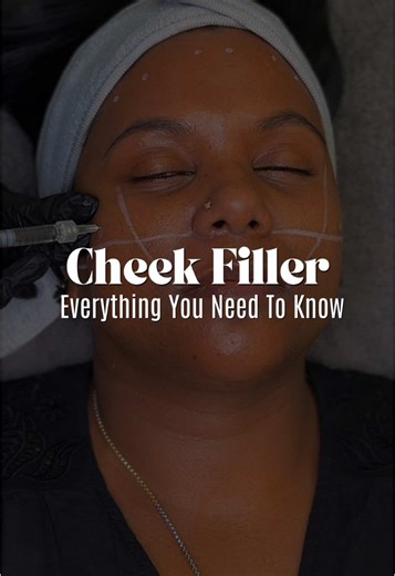 When done right, cheek fillers don’t just add volume—they contour, lift, and enhance your natural beauty in the most effortless way. ▫️Cheek fillers add definition and lift, not just volume ▫️Discomfort? Minimal—thanks to numbing and gentle techniques ▫️Safety is key—always go to an experienced injector ▫️Fillers pair well with skin boosters, Botox & Morpheus 8 for next-level results ▫️Less is more—we start subtly and build if needed Drop any questions below—I’m here to help. #CheekFillers #Glow