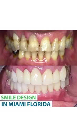 🇺🇸 Smile Design in Miami Florida 🙌 At The Smile Mission we thrive to give you the best smile. We will take care of your oral health with our professional team to complete your smile! 😁 #dentistryworld #extractions #thesmilemissionmiami #dentalcrowns #dentalclinic #dentaloffice #dentures #dentistry #implants #veneer #dental #dentalcleaning #braces