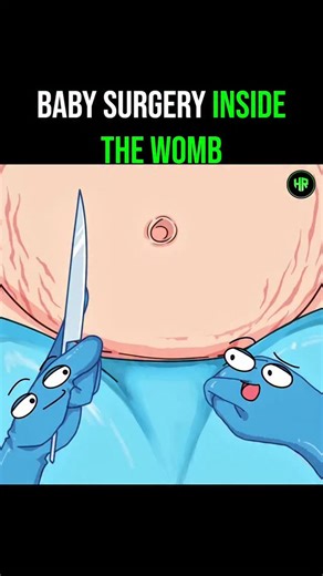 Healthrivex | Daily Health Tips on Instagram: "This animation illustrates a fascinating medical procedure known as open fetal surgery. Did you know doctors can sometimes operate on a fetus before it is even born? In critical cases, surgeons open the mother's uterus to access the unborn baby and correct life-threatening defects like spina bifida or heart issues. As shown in the video, the baby is sometimes partially removed to perform the delicate surgery and then carefully returned to the womb t