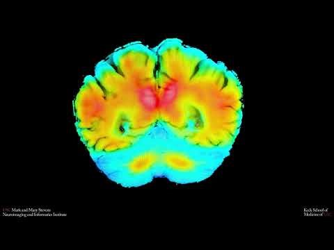 Amyloid PET imaging to measure plaque buildup in the brain