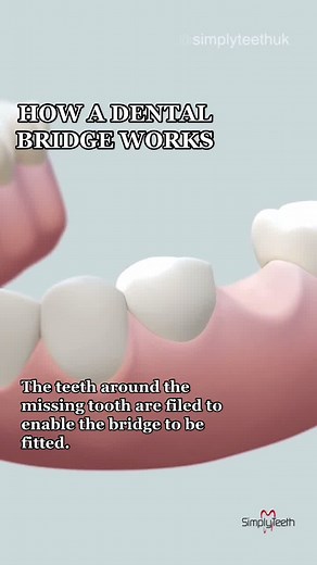 simplyteethuk on TikTok