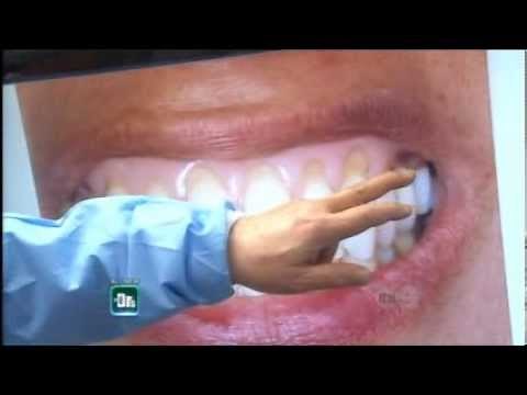 Chao Pinhole Gum Rejuvenation™ As Seen On The Doctors