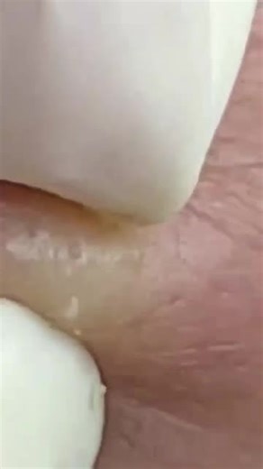 Blackheads Removal At Spa Skin Care enjoy naturally ##Blackheads #extractions #puntosnegros #blackpink #people