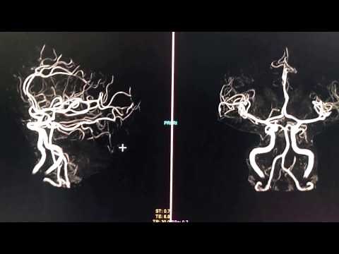 3D Image of the Brain Vasculature (MRA)