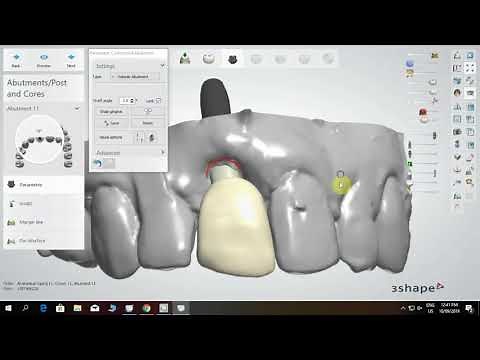 Customized Abutment using DIO H-Scan Body