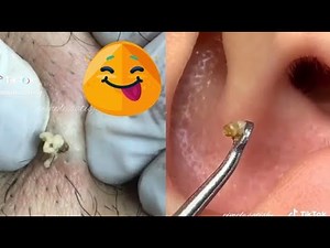 Mastering Blackhead Removal: Expert Tips for Clear Skin!