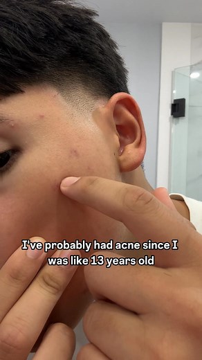 NEW #1 Men's Acne System ✨ Clears Your Acne Fast 🌿 Natural Ingredients 🪶 Gentle & Smooth ‍🔬 FDA-Approved Join 270,000 and get the #1 boys' acne system. With our Black Friday sale, you get 60% off plus free shipping, free body wash and a 100-day money-back guarantee. | Mathew torrejon