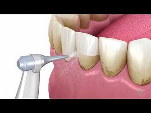 Professional Dental Hygiene | Air Flow Teeth Cleaning in Sidcup