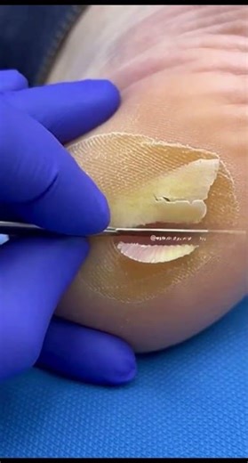 Extreme Heel Callus Removal Satisfying Podiatry #podiatry #peliculas #asmr