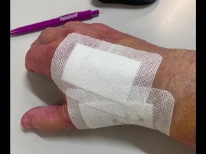 CMC Trapeziectomy Suspensionplasty Day 8 #reconstructionsurgery #surgeryrecovery #surgerysuccess