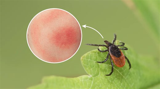 Do you know the signs of a tick bite? What to look for
