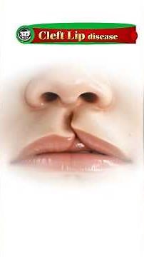 Cleft Lip | Causes, Types & Treatment | Generic Disorder