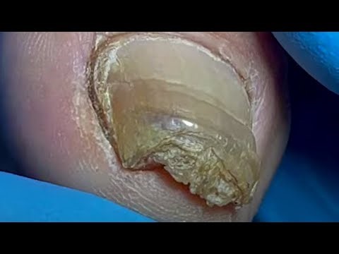 Super Thick Onychomycosis! The Nail Is Embedded Into The Nail Groove