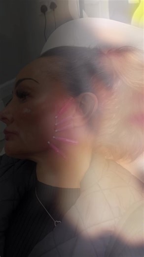 Its been a busy week for mono threads How do they work? The threads are inserted just under the epidermis to trigger a healing response, which encourages the production of new collagen and elastin. Firming and tightening: This new collagen creates a supportive network in the skin, leading to improved firmness and a tighter appearance. Dissolving threads: The PDO threads are biocompatible and safely dissolve within 6-8 months, but the collagen they stimulated remains, providing long-lasting effec