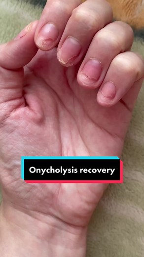 Effective Onycholysis Recovery Strategies