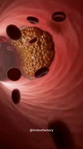 Sweden’s Nanobots Cleared Arterial Plaque in Minutes — Signaling a Radical Shift in Heart Disease Treatment (Experimental Research) Researchers in Sweden have demonstrated a striking nanomedicine breakthrough: experimental nanobots capable of targeting and breaking down arterial plaque inside blood vessels in a matter of minutes—at least under controlled laboratory and early research conditions. The concept challenges decades of conventional cardiovascular treatments that rely on repeat surgerie