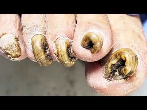 Clearing Years of Thick Fungal Nail Growth Step by Step【Dr. Liu's Pedicur】